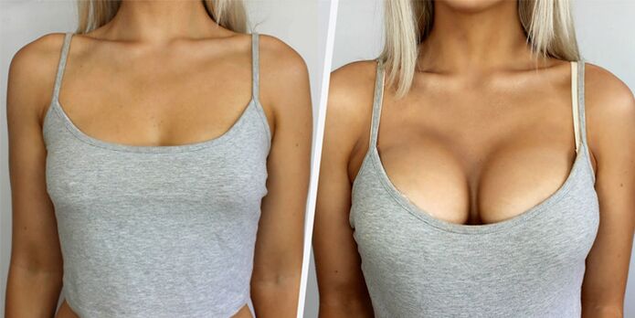 pred in po plastični operaciji za povečanje prsi