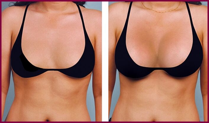 pred in po povečanju prsi z maščobo