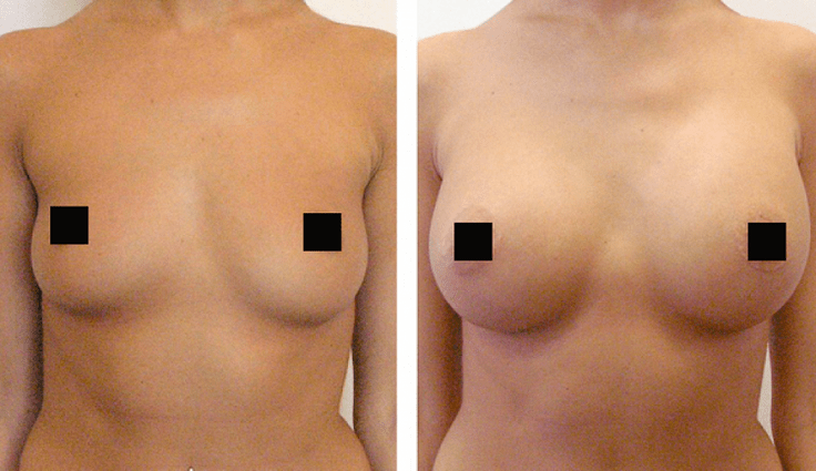 prsi pred in po povečanju s hialuronsko kislino