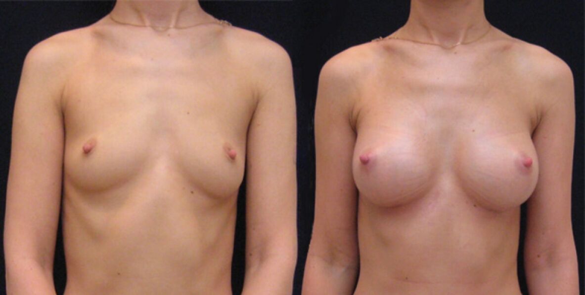 prsi pred in po endoskopskem povečanju