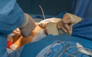 kako se izvaja operacija povečanja dojk