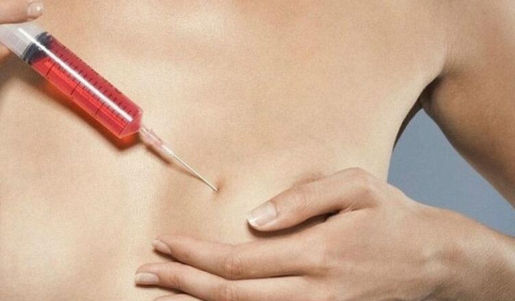 Povečanje prsi z injekcijami hialuronske kisline