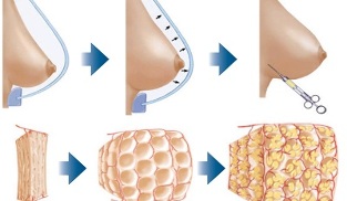 kako se postopek povečanja dojk izvaja z maščobo