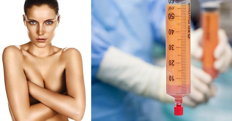 lipofilling kot metoda za povečanje prsi